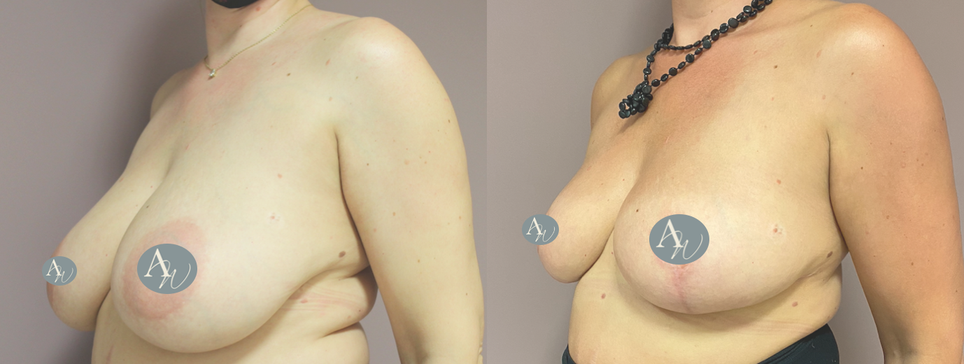 Avant/Après lifting seins et réduction mammaire